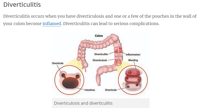 diverticulosis